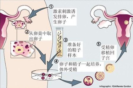 关于供卵代孕要多少费用